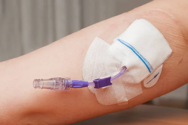 Picc (Periferik Merkez Kateter) genç bir kadının kolunda bulunur. Piknik uzun süreli kemoterapi, antibiyotik tedavisi veya tam parenteral beslenme için kullanılabilir..