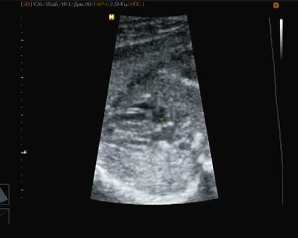 Ultrasonografie voor heartbeat van de kleine baby. — Stockvideo