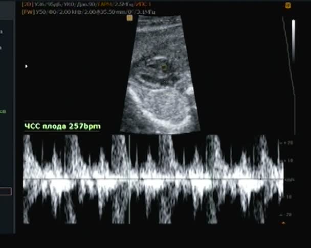 Ultrasonografie voor heartbeat van de kleine baby. — Stockvideo