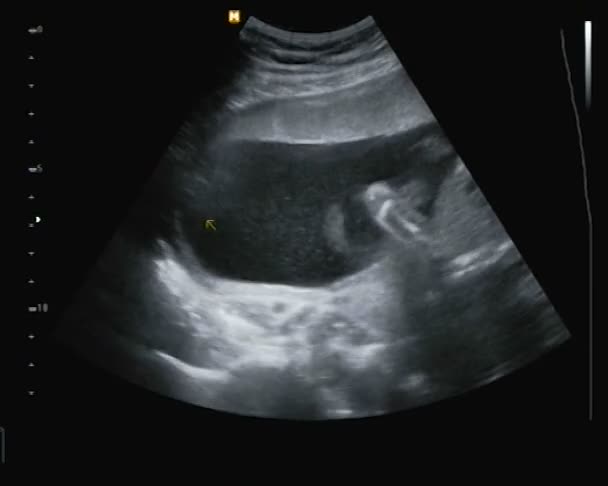 Ultrasonography of the small baby. — Stock Video