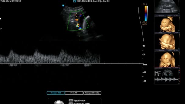 Rastreamento por ultrassom médico — Vídeo de Stock