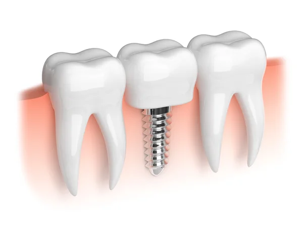 Modelo de dientes e implante dental — Foto de Stock