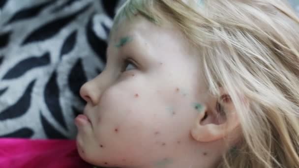 Una enfermedad infecciosa en una niña, varicela en la cara. Tratamiento del virus del herpes, varicela — Vídeo de stock