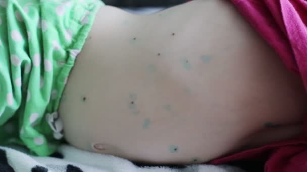 Erupción en la piel del abdomen en un niño enfermedad infecciosa varicela, período de incubación — Vídeos de Stock