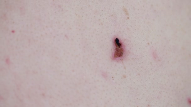 Odstranění papilomu na lidské kůži, pozadí, detailní záběr. Vypalování papilomů laserem, lékařským, dermatologem — Stock video