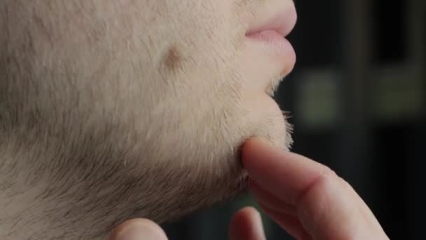 A young caucasian man with red stubble and a double chin with a mole on his cheek smiles for the camera. Aesthetic defect, fatty deposits on the chin — Stock Video