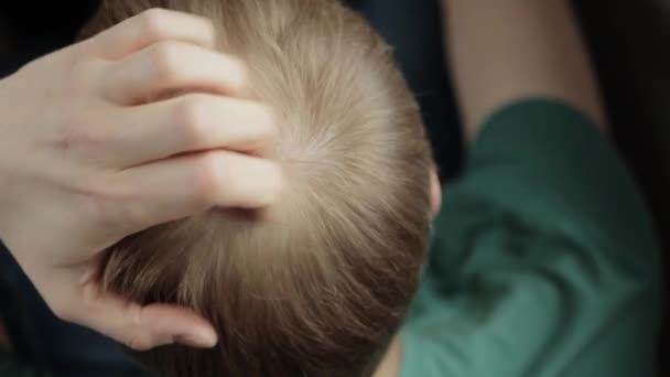 Een terugtrekkende haarlijn op het hoofd van een jongeman. Kaalheid bij jongeren, behandeling van haarfollikels, close-up — Stockvideo