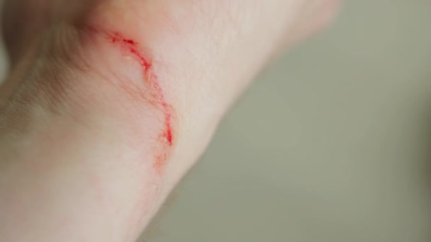 Sebhely egy férfi kezén, közelkép. Vér a csuklón, bőr. — Stock videók