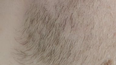 Genç bir adamın sakalındaki kırmızı sakalın dokusu, makro. İnce saçlar, dermatoloji.