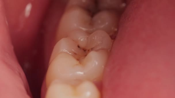 Cissen in de mond op de kauwtanden. Installatie van hoogwaardige tandheelkundige vullingen. Tandheelkundige behandeling in de moderne tandheelkunde, macro — Stockvideo