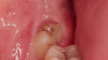 Impacted wisdom tooth due to which a gum hood was formed. Inflammation of the gums due to an unerupted molar, macro