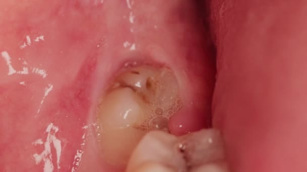 Un dinte de înțelepciune afectat datorită căruia s-a format o capotă gingivală. Inflamația gingiilor din cauza unui molar neerupt, macro — Videoclip de stoc