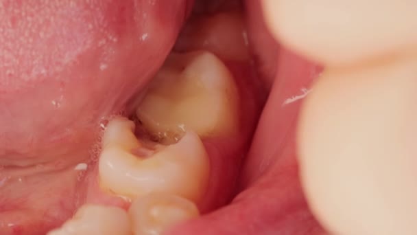 Un dente con carie profonda nella bocca dei pazienti, primo piano. Odontoiatria trattamento dentale, patologia — Video Stock