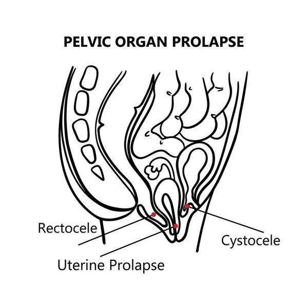 Pelvisk Organ Prolapse Monochrome Kvinnor Allmän Diagram Med Förklarande Text — Stock vektor