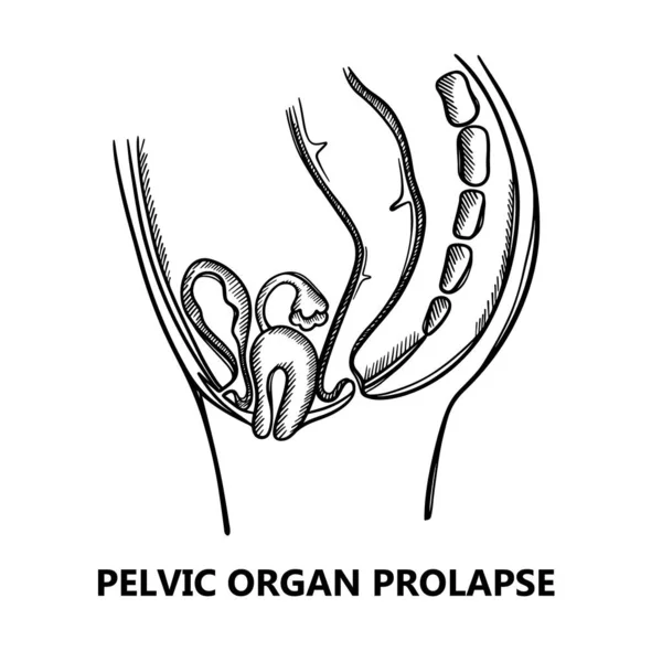 Pelvic Organ Prolapse Sketch Women Diagrama General Monocromático Para Educación — Vector de stock