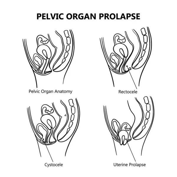 Pelvic Organ Prolapse Variously Monochrome Women General Diagram Explanatory Text —  Vetores de Stock