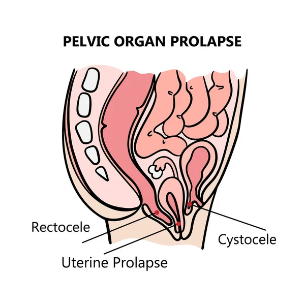 Pelvic Organ Prolapse Women General Diagram Explanatory Text Medical Education — Stock Vector