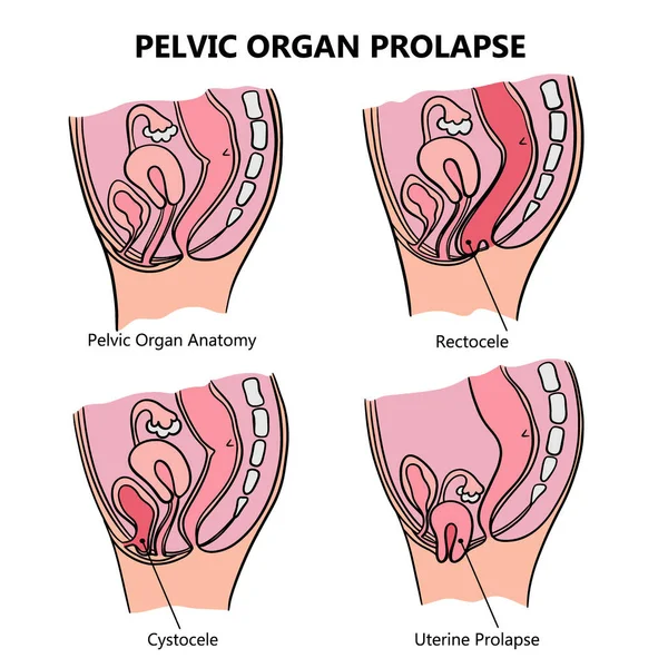 Pelvic Organ Prolapse Variously Women Általános Ábra Magyarázó Szöveggel Orvosi — Stock Vector