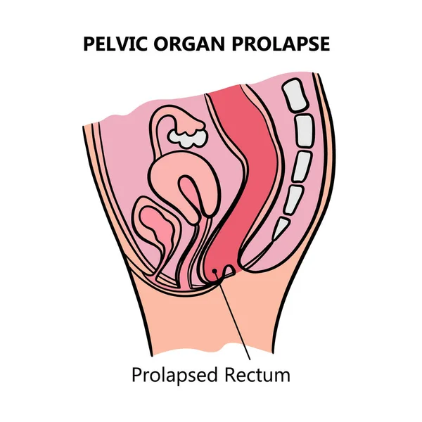Prolapsed Rectum Women General Diagram Explanatory Text Medical Education Clip — Stock Vector