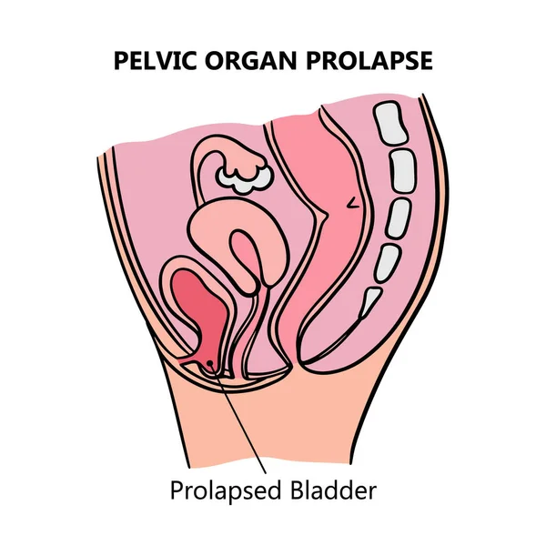 Prolapsed Bladder Kvinnor Allmän Diagram Med Förklarande Text För Medicinsk — Stock vektor