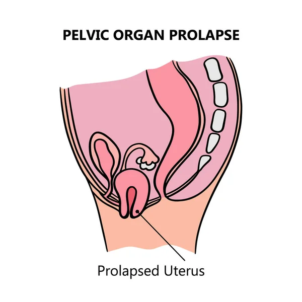 Prolapsed Uterus Women General Diagram Explanatory Text Medical Education Clip — Stock Vector