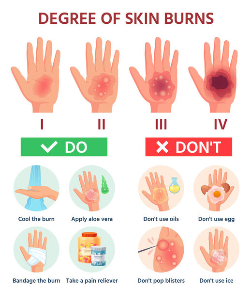 Burns degree. First aid for burn wound. Fire damage to skin classification. Hand blisters. Vector infographic treatment for thermal wound