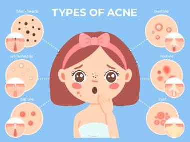 Girl with acne. Young unhappy female face with skin problems and pimple types icons. Dermatology and cosmetic skin care vector infographic clipart