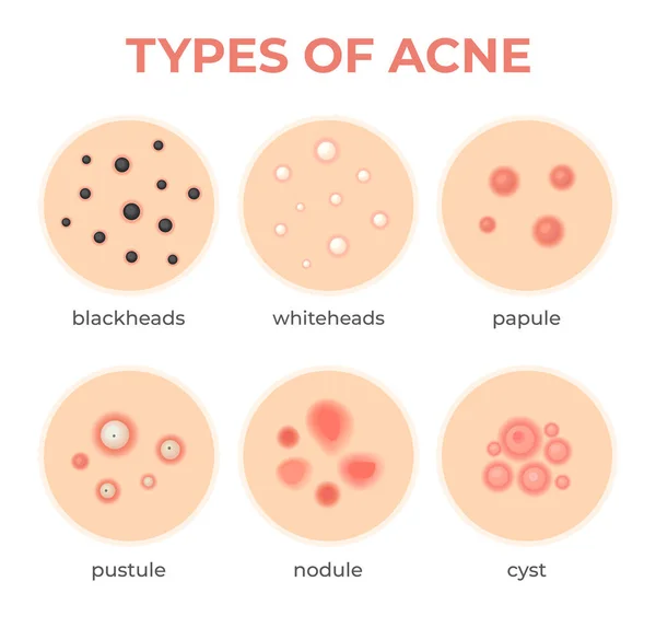 Tipi di acne. Problema di infezione della pelle, brufoli grado e tipo cisti, whitehead, punti neri, nodulo e cistica. Set vettore della malattia dei pori del derma — Vettoriale Stock