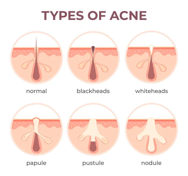 Tipi di acne anatomia. Pimple malattie vista sezionale blackhead, cistica e whitehead. Struttura dell'infografica vettoriale dell'infezione cutanea e dei pori — Vettoriale Stock
