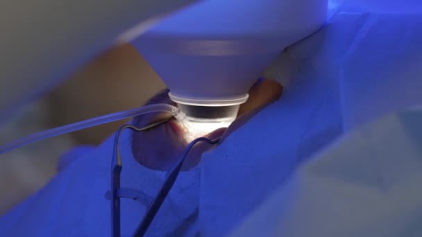 Лазерная коррекция глаз методом SMILE — стоковое видео