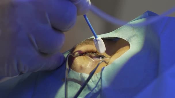 Correction des yeux au laser par la méthode SMILE. Docteur frotte les yeux avec du coton — Video