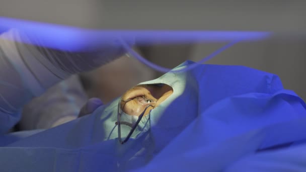 El médico utiliza gotas para los ojos para los pacientes ojos durante la cirugía de visión láser. — Vídeos de Stock