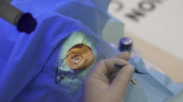 Chirurg verwijdert een deel van het hoornvlies uit het oog met pincet na laserblootstelling — Stockvideo