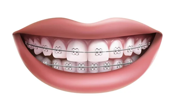 Beyaz Arkaplanda Izole Edilmiş Vektör Beyaz Dişler Diş Telleriyle Gülümse — Stok Vektör