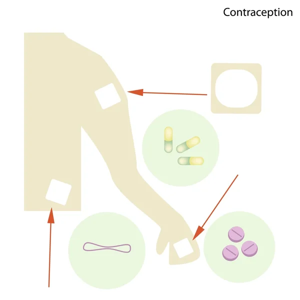 Diferentes elementos anticonceptivos y anticonceptivos — Archivo Imágenes Vectoriales