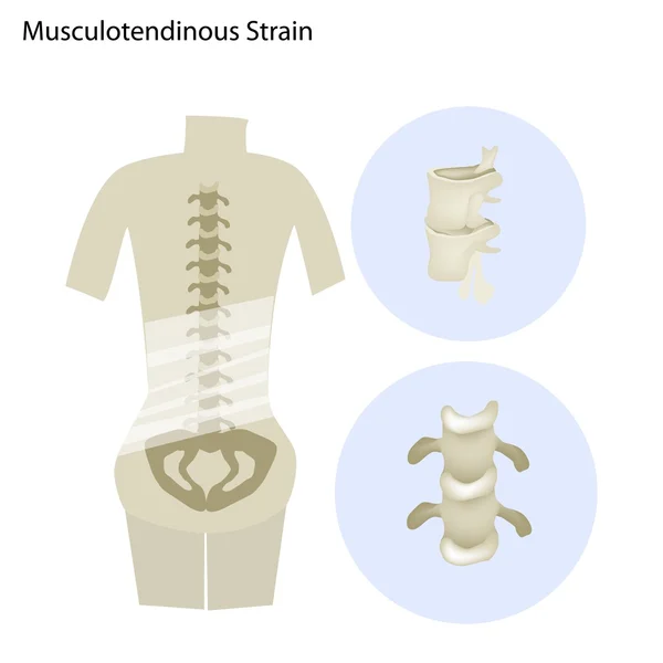 Ilustración de distensión musculotendinosa o columna lumbar — Vector de stock