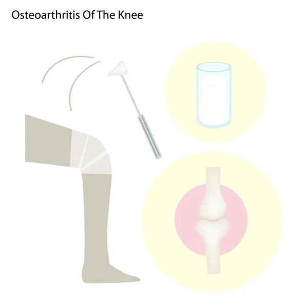 Juego de ilustraciones de Osteoartritis de rodilla — Vector de stock