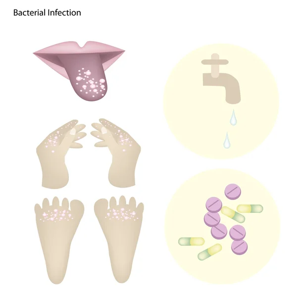 Infection bactérienne par la prévention et le traitement des maladies — Image vectorielle