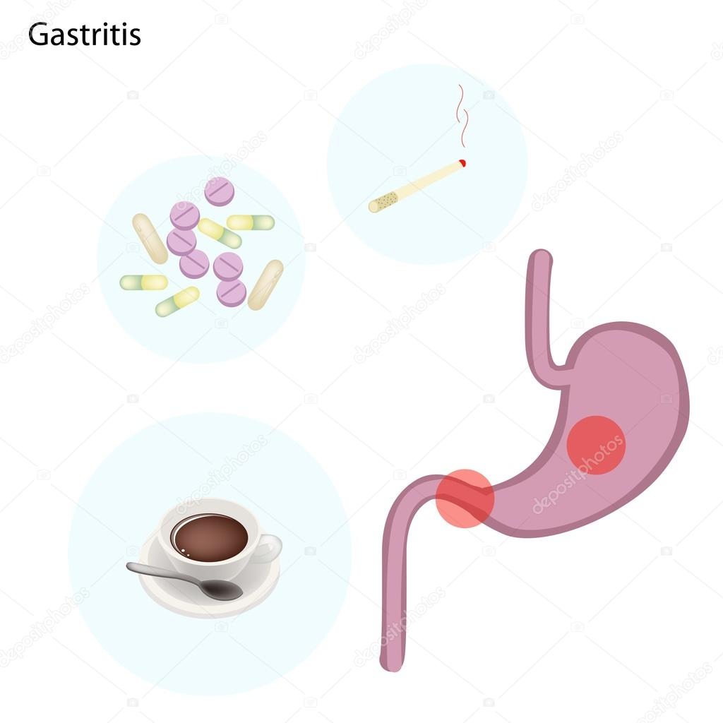 Medical Concept, Illustration of Gastritis Can Be Caused by Excessive Alcohol, Caffein, Nicotine