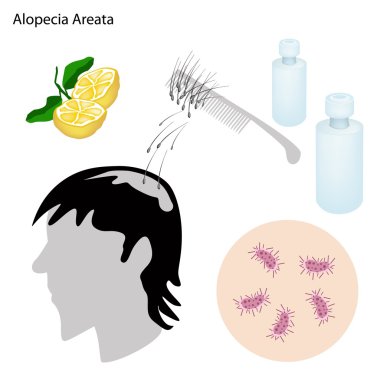 Alopesi Areata hastalığı önleme ve tedavi ile