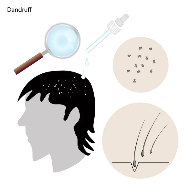 疾病预防和治疗头皮屑 — 图库矢量图片