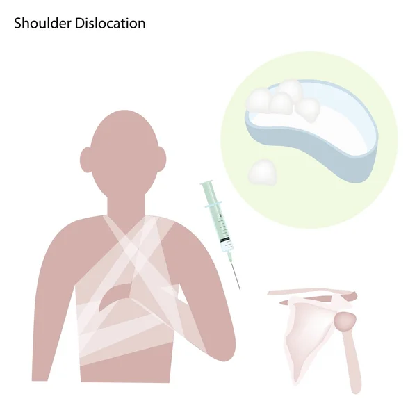 Dislocación recurrente del hombro con tratamiento médico — Vector de stock