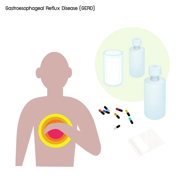 Maladie du reflux gastro-œsophagien ou RGO avec traitement — Image vectorielle