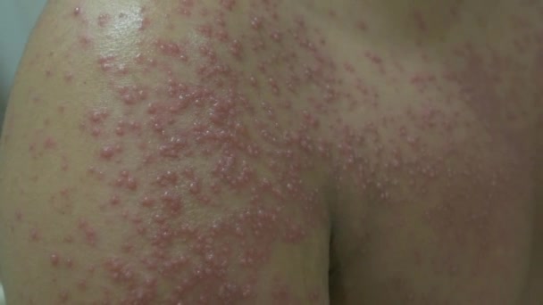 Tenggarong Indonésia 2019 Julho Close Patient Who Having Varicella Chickenpox — Vídeo de Stock