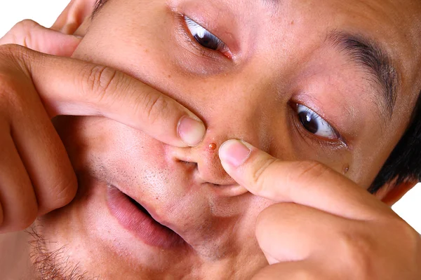 Jeune homme serrant l'acné — Photo