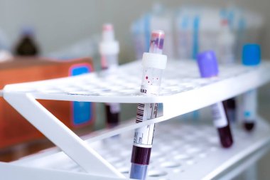 Tedavi odasındaki bir tripoda analiz için venöz kanla test tüpü, hastalık teşhisi, koronavirüs için kan testi.