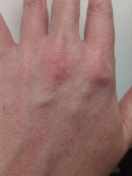 Utslag Och Nässelfeber Baksidan Kvinnlig Hand Allergisk Hudreaktion Sjukdom Kroppens — Stockfoto