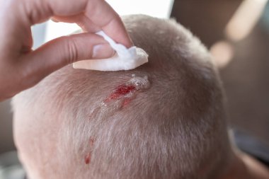 Injury to the scalp. Blood leaks from a chopped wound on the head. A woman is cleaning a wound with a cotton swab with hydrogen peroxide. First aid. clipart