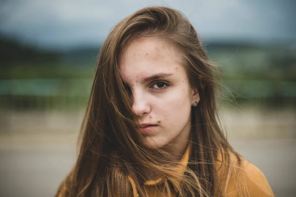 Porträt Einer Jungen Hübschen Teenagerin Mit Frackings Und Problematischer Haut — Stockfoto