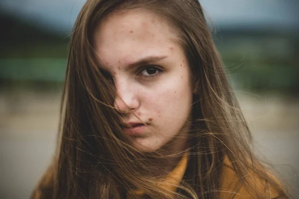Портрет Молодої Красивої Дівчини Підлітка Тріщинами Проблемною Шкірою Природному Тлі — стокове фото
